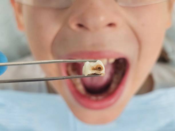 Best Dentist for Tooth Abscess  in Hayden, AL